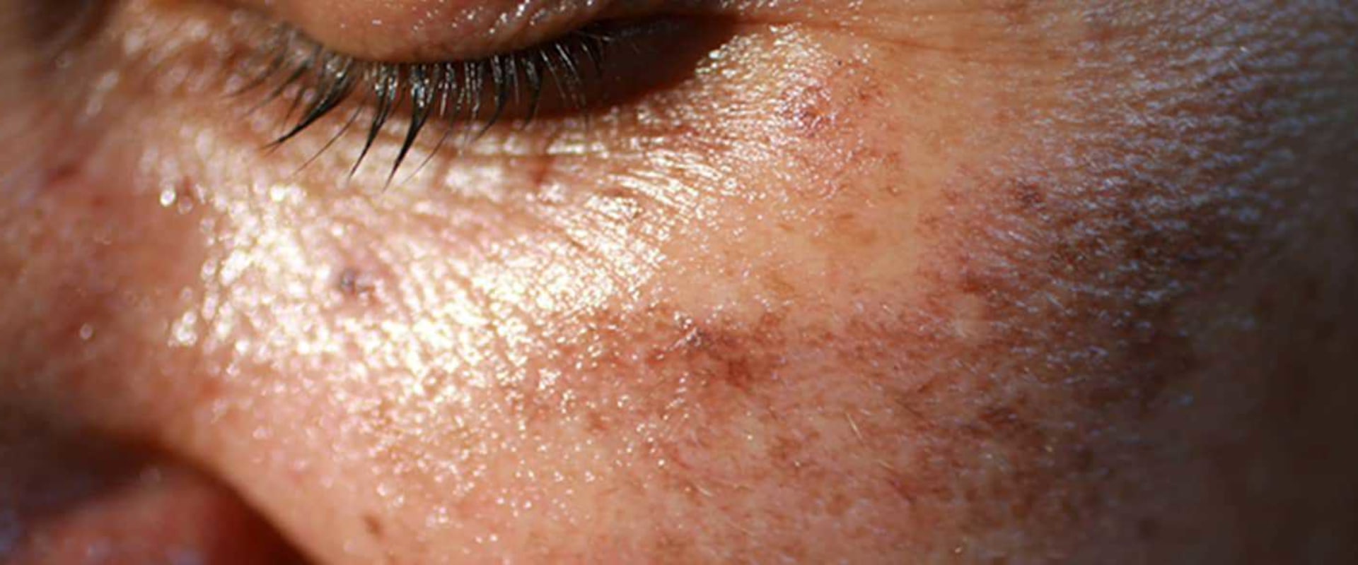 Understanding Dark Skin Pigmentation: A Comprehensive Guide to Vitamin D3 Benefits, Sources, and Deficiencies