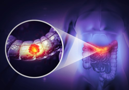 The Link Between Vitamin D3 and Cancer Prevention