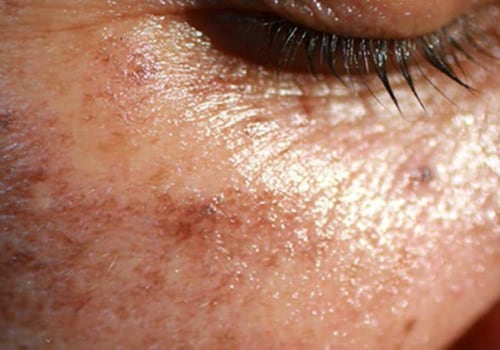 Understanding Dark Skin Pigmentation: A Comprehensive Guide to Vitamin D3 Benefits, Sources, and Deficiencies